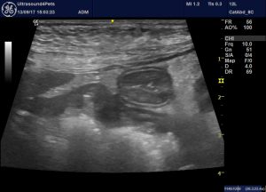 abnormal pancreas ultrasound