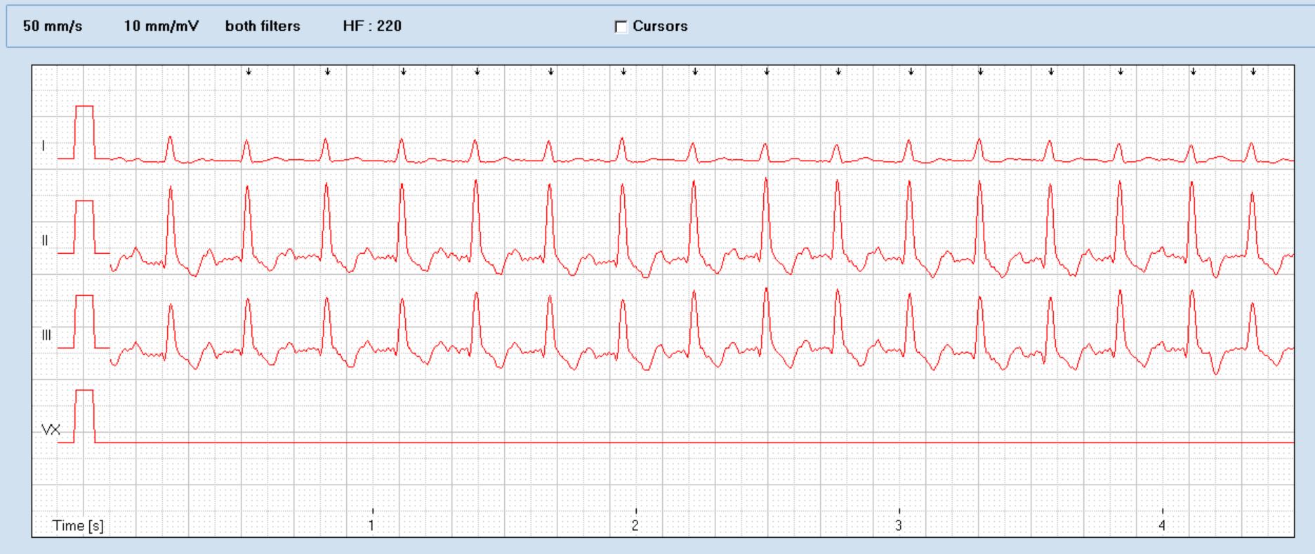 Paroxysmal supraventricular tachycardia in an old Bouvier – Vet ...