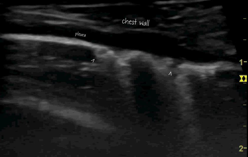 Lung Ultrasound In The Diagnosis Of Presumed Pulmonary Mycobacteriosis ...